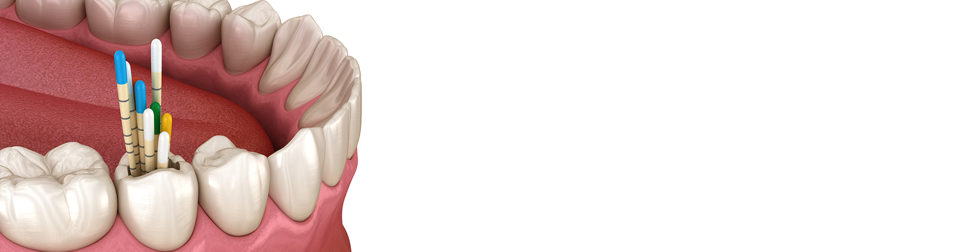 rendering of a lower jaw with gutta percha being placed into a tooth